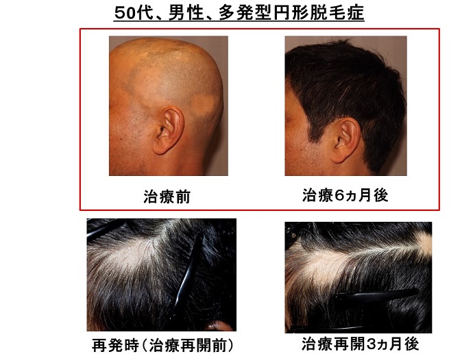 円形脱毛症　病院